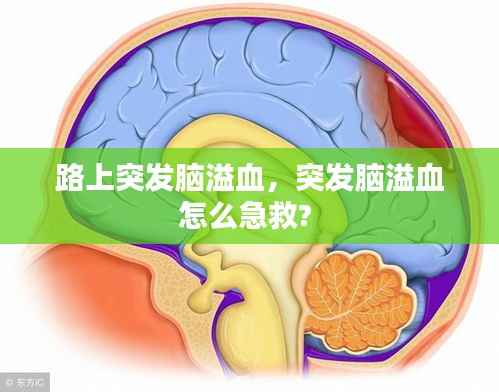 路上突发脑溢血,突发脑溢血怎么急救?